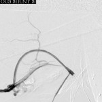 Right brachial arteriogram during intervention: Proximal brachial artery patent.