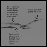 Fistulagram before interventions showing stenosis of the distal left brachial vein.