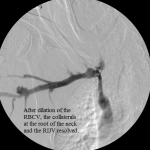 Central venogram post-dilation of the RBCV: the venous collaterals are resolved.
