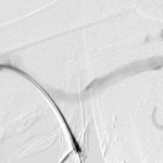 Right brachial venogram during intervention showing collaterals bypassing subclavian stenosis.