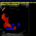 Color doppler ultrasound of the aneurysm of the distal left brachial artery.