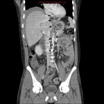Reformatted abdominal CT: There is an OptEase filter in the inferior vena cava