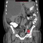 Coronal CT abdomen and pelvis showing the distal end of the left ureteral stent in the urinary bladder.