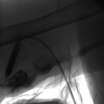 Image during intervention: angioplasty of 1st and 2nd stenoses.