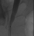 Distal left ureter after dilation