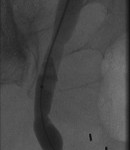 Distal left ureter during dilation