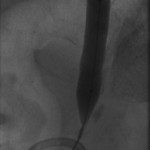 Distal right ureter at full balloon inflation