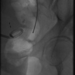 Distal right ureter before dilation.