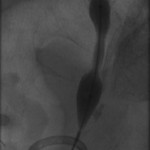 Distal right ureter during dilation
