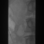 Frontal abdominal fluoroscope: The OptEase filter is absent.