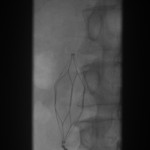 Frontal abdominal fluoroscope: The filter is snared, ready for collapse.
