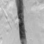Final inferior vena cavagram: Filter removed without complications.