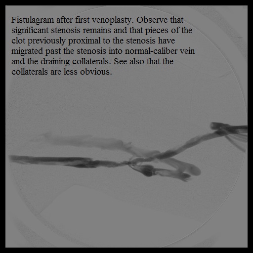 Fistulagram after first balloon dilation of the stenosis in the distal left brachial vein.