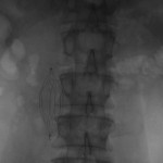 Frontal abdominal fluoroscope: The filter has not moved.