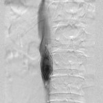 Inferior vena cavagram before filter retrieval: The axes of the filter and IVC are concordant.