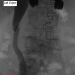 Left ureter before ballooning