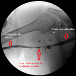 Right arm venogram: long smooth brachial vein stenosis distal to the graft.