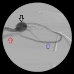 Left forearm loop graft angiogram: Large aneurysm of the distal left brachial artery (black arrow); the loop graft (blue arrow); the left brachial vein (red arrow).