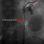 Frontal fluoroscope after left ureteral stenting and rescue left nephrostomy catheter.