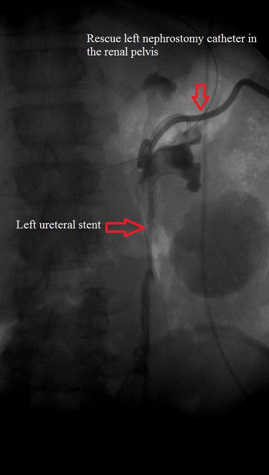 Post ureteral stenting and nephrostomy catheter insertion Medrad Clinics
