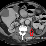Axial CT scan of the abdomen before left ureteral stenting showing dilated left ureter.