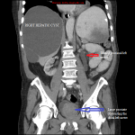 Coronal CT abdomen and pelvis showing dilated upper left ureter and a large prostate.