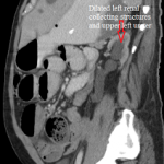 Sagittal CT abdomen and pelvis showing dilated left ureter and calyces