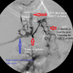 Central venogram. Note numerous collaterals bypassing the occluded RBCV.