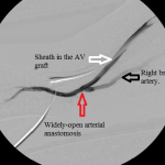 Angiogram of the arterial anastomosis: there is no stenosis at the arterial anastomosis.