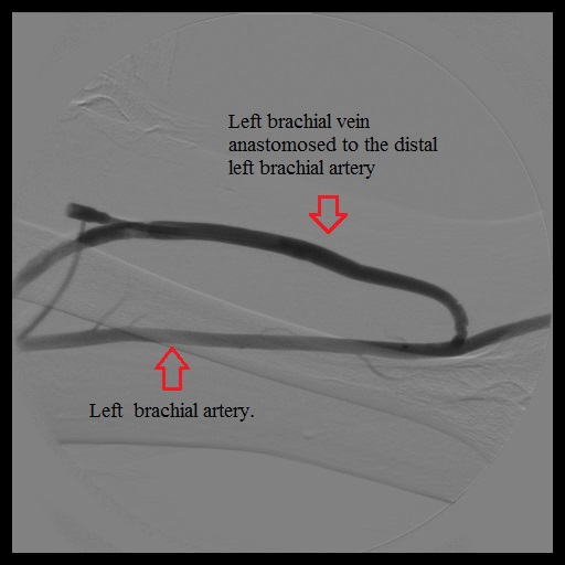 Final fistulagram of the AVF showing the proximal left brachial vein and the distal left brachial artery.