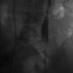 Right and left ureters after nephroureteral stenting.