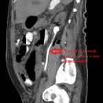 Sagittal CT abdomen and pelvis after left ureteral insertion showing a decompressed collecting system