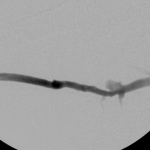 Right arm venogram post intervention: complete elimination of the stenosis.