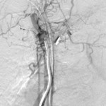 Terminal central venogram through the REJV: A guidewire has been passed through the recanalized vein into the IVC.
