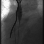 Mid-phase balloon inflation of the RBCV and SVC: Incomplete dilation of the central veins.
