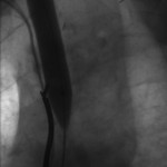 Late-phase balloon inflation: Complete dilation of the central veins.