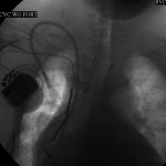 Fluoroscope of the chest after intervention: A double-lumen catheter is tunneled into the right atrium.